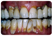 Paradontologia: cura delle gengive, dell’osso e dei tessuti di sostegno del dente.