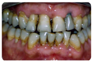 Paradontologia: cura delle gengive, dell’osso e dei tessuti di sostegno del dente.
