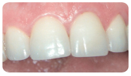 Faccette estetiche di porcellana senza metallo.