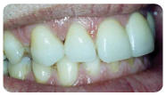 Faccette estetiche di porcellana senza metallo.